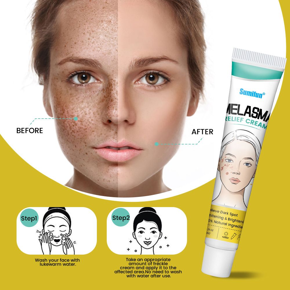 sumifun Melasma Cream For Dark Spots Premium Cream For Age Spots Sun Spots And Freckles Hand Spots Knee And Thigh Spots