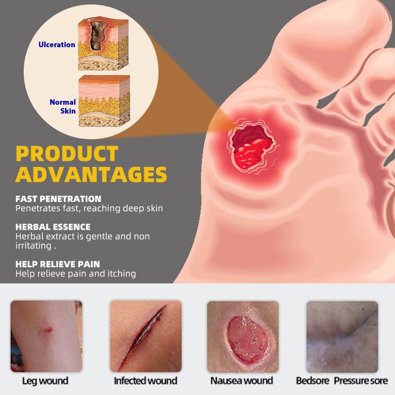 sumifun Bedsore Treatment Cream Pressure Sore Ulcer Skin Rot Necrotic Repair Ointment Bed Sore Wound Healing Decubitus Feet Care Gift