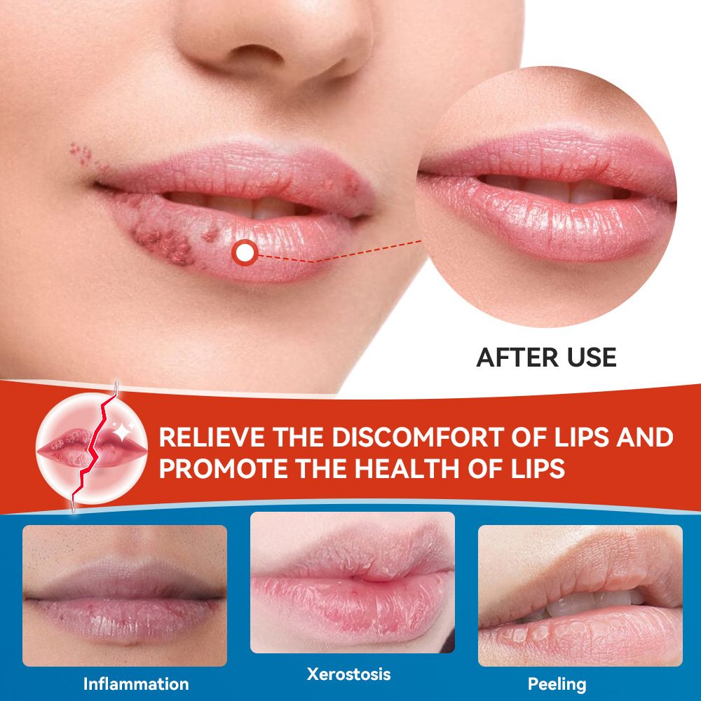 sumifun Cheilitis Cream Inflammation Labial Herpes Antibacterial Ointment Chapped Lips Wrinkles Rehydration