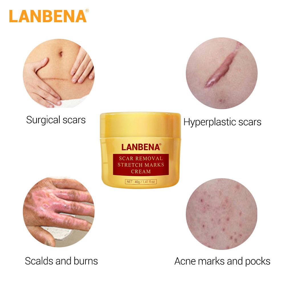 LANBENA Acne Scar Removal Cream Stretch Marks Repair Cream Face Acne Spots Treatment Blackhead Whitening Shrink Pores Skin Care