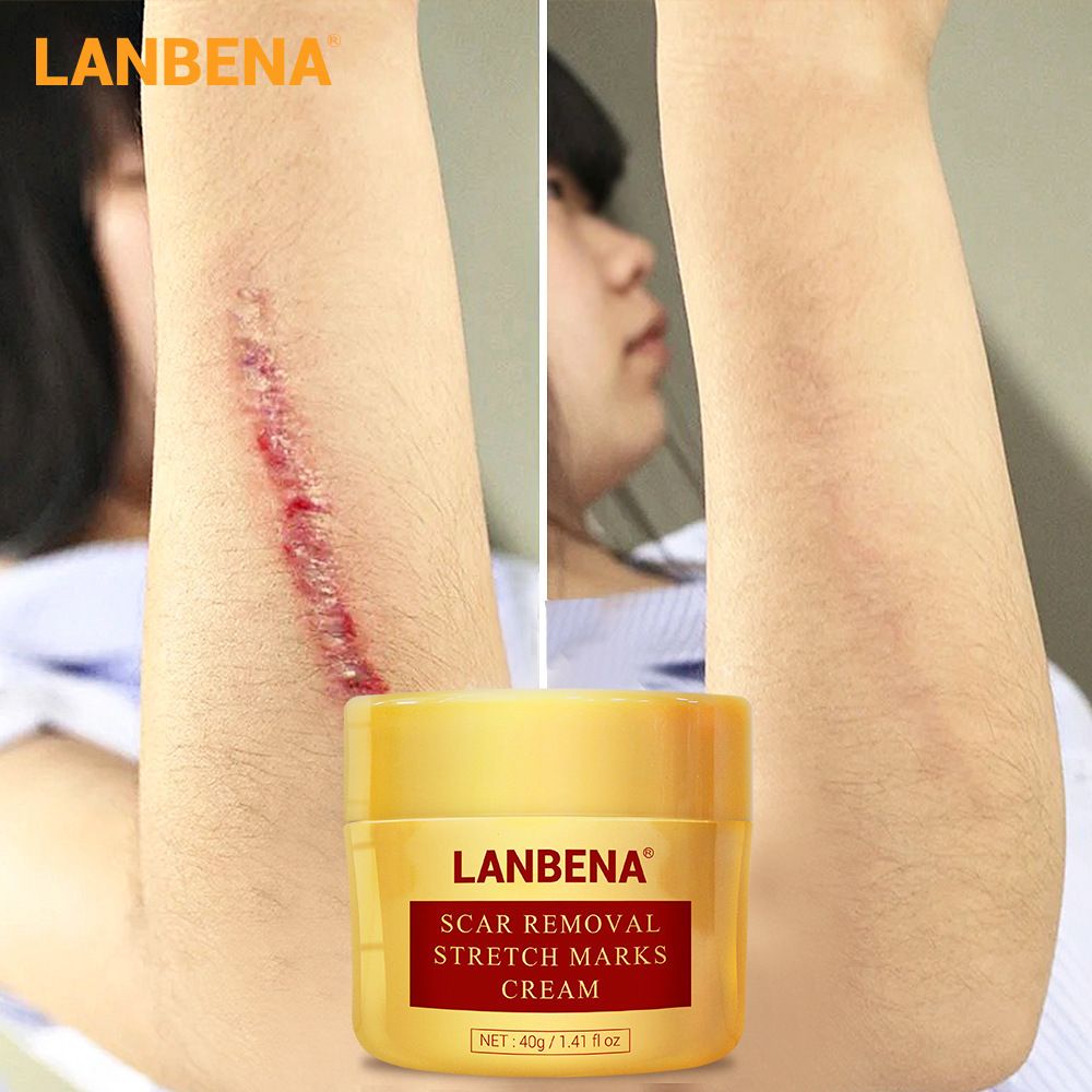 LANBENA Acne Scar Removal Cream Stretch Marks Repair Cream Face Acne Spots Treatment Blackhead Whitening Shrink Pores Skin Care