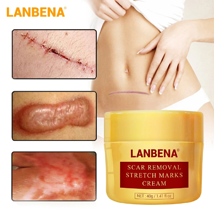 LANBENA Acne Scar Removal Cream Stretch Marks Repair Cream Face Acne Spots Treatment Blackhead Whitening Shrink Pores Skin Care