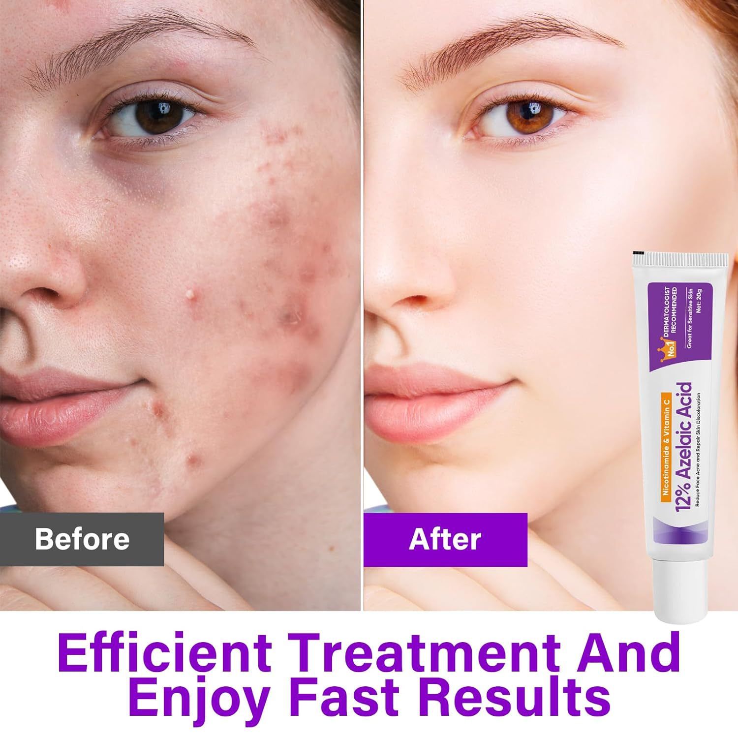 Azelaic Acid 12% Serum Azelaic Acid Cream Nicotinamide Serum Smooth Skin Azelaic Acid 12% Serum Cream Facial Redness