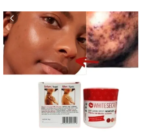 White Secret Dark Spot Remover Cream Corrects Acne Scars & Black Spots
