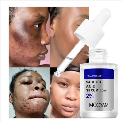 Salicylic Acid Serum Acne Remover Pimples Remover Acne Repair Oil Control Salicylic Acid Serum 30ml Dark Spot Remover Blackhead Cleansing Nourishing - MOOYAM
