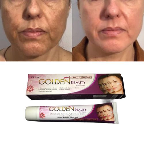 Golden Beauty Acne Spots Scars Hyperpigmentation Melasma Dark Under Eye Suntan Removal Cream Tretinoin Mometasone Hydroquinone 10 days Cream