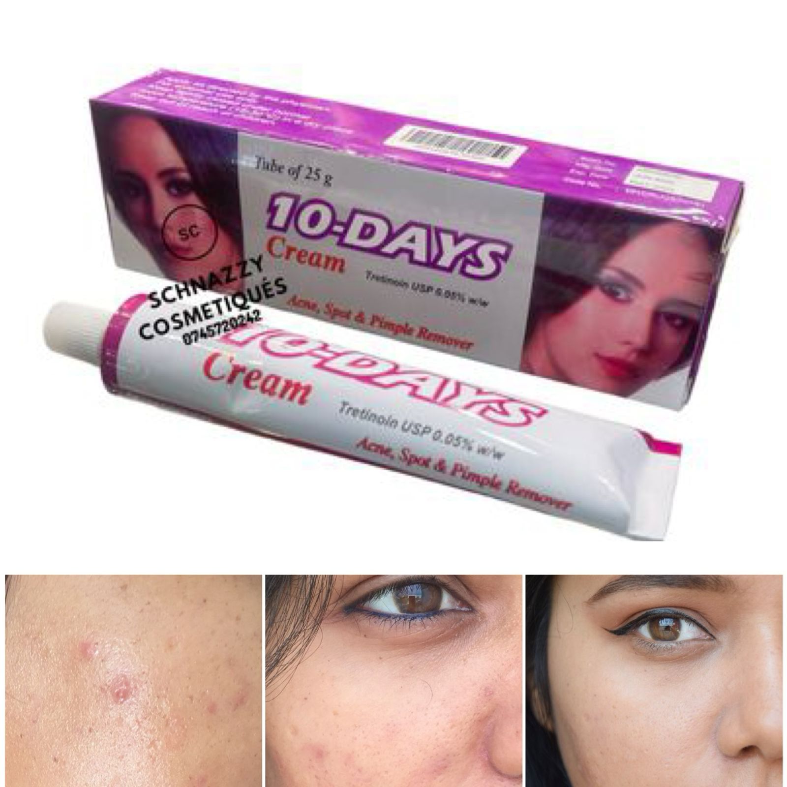 Golden Beauty Acne Spots Scars Hyperpigmentation Melasma Dark Under Eye Suntan Removal Cream Tretinoin Mometasone Hydroquinone 10 days Cream