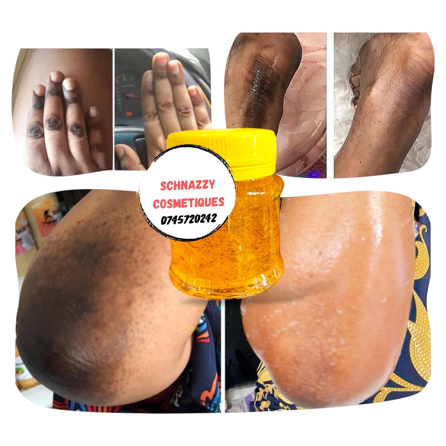 Dark Knuckles Gel Hyperpigmentation Discoloration Fades Stubborn Marks (Not for Face) Elbows Knees Hands Toes Feet Armpits Dark Inner Thighs (KENNITE)