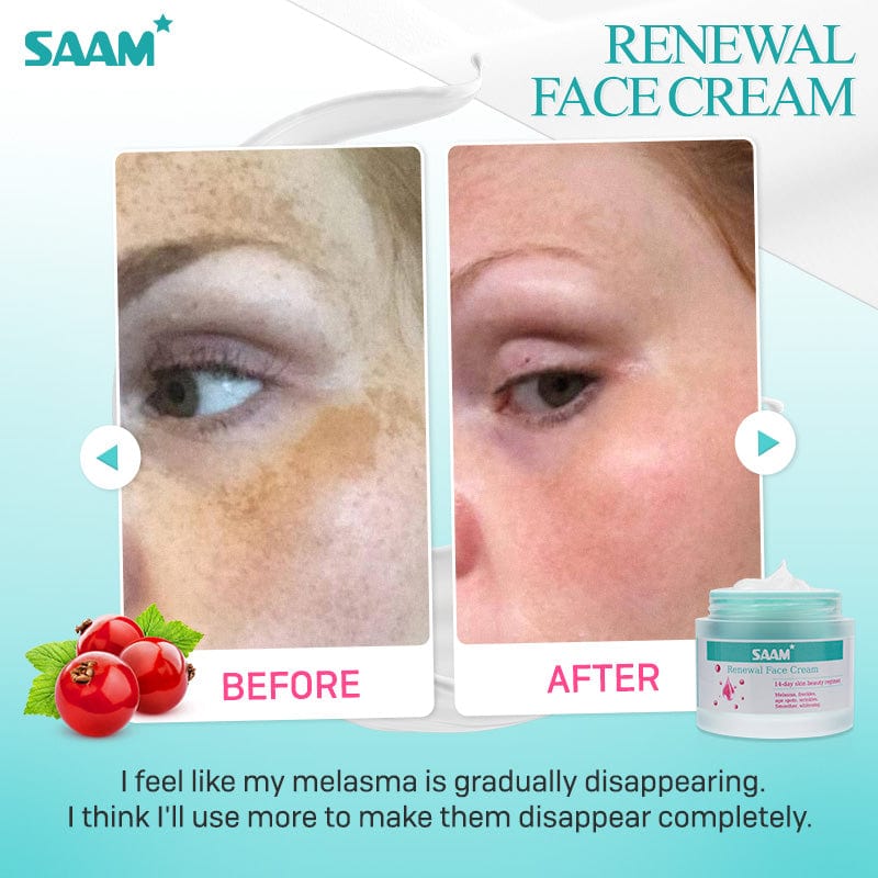 Trending Bestseller SAAM Renewal Face Cream for Melasma Age Spots Hyperpigmentation Sunburn Red Face Reveal  Brighter Even Toned Radiant Skin