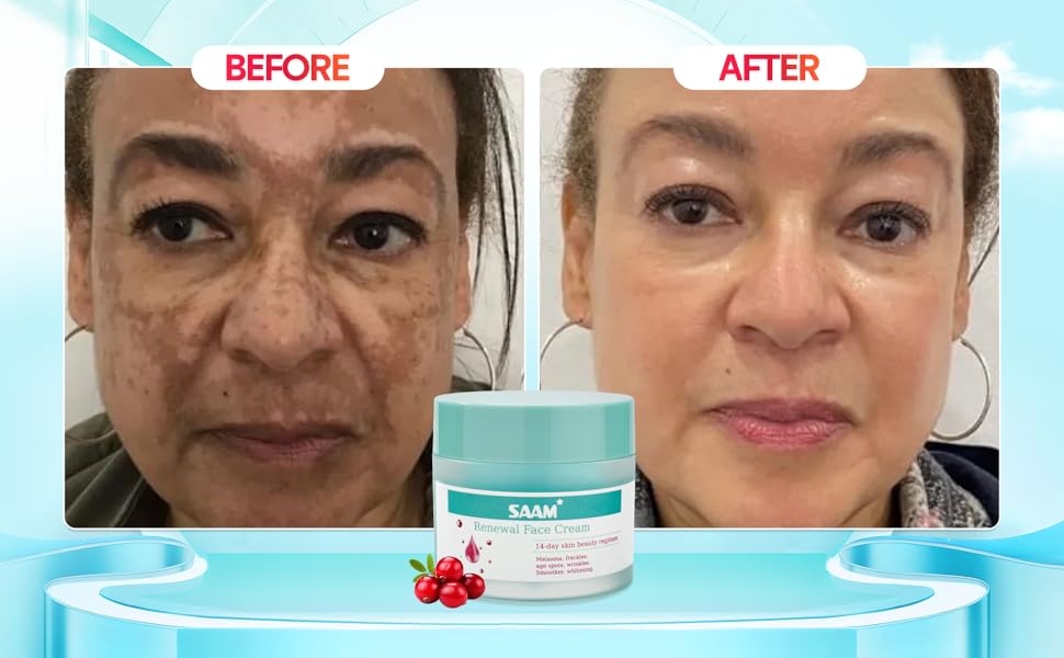 Trending Bestseller SAAM Renewal Face Cream for Melasma Age Spots Hyperpigmentation Sunburn Red Face Reveal  Brighter Even Toned Radiant Skin