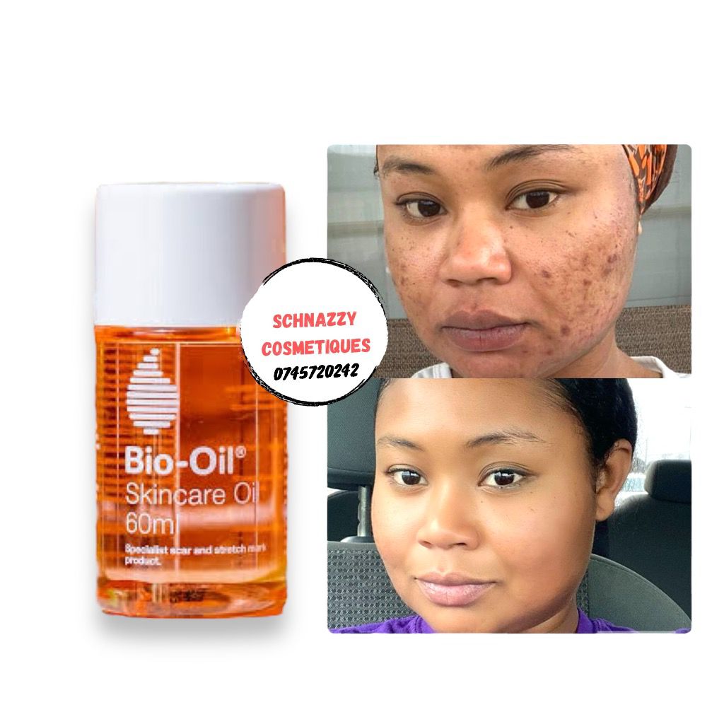 BIO OIL Face & Body Oil Acne Scars Stretchmark Treatment for Acne Scar Removal Pigmentation Discoloration Dark Spots Stretch Marks & Anti-ageing Healthy Skin