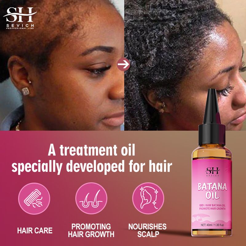 SEVICH 100% Pure Batana Oil For Hair Growth Africa Crazy Traction Alopecia Batana Hair Mask Anti Hair Break Hair Strengthener Hair Loss Treatment Essence For Black Men & Women Batana Oil From Honduras
