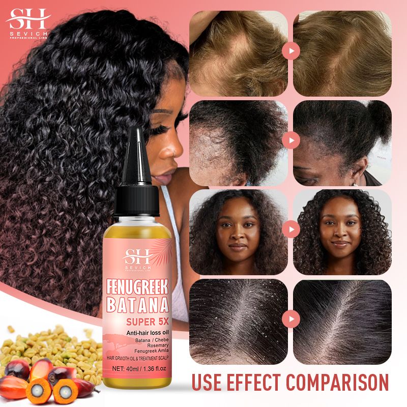 SEVICH Super 5x Batana Oil For Hair Growth Africa Traction Alopecia Treatment Chebe Powder Oil Rosemary Treatment Prevent Hair Loss Serum Essence Liquid Fenugreek Fast Regrowth Thicken Oil Hair Care