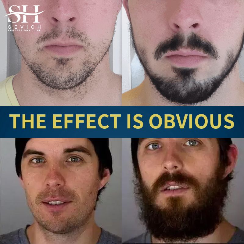 SEVICH 5% Minoxidil Beard Growth Oil 30ml Beard Oil Beard growth essential oil and Hair Growth Essential oil, bald hair treatment oil Men's Beard Growth Essence Nourishing Enhancer Beard Oil Spray