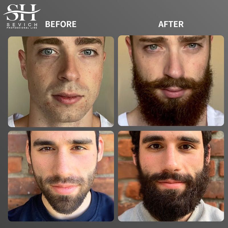 SEVICH Chebe Oil Men's Beard Growth Oil 30ml Beard Growth Essential Oil Bald Hair Treatment Oil Fast Hair Growth Oil Beard Growth Essence Nourishing Enhancer Beard Oil Spray Beard Care