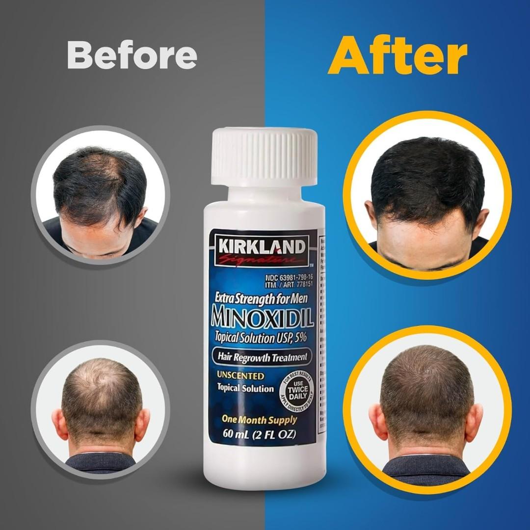 Kirkland Signature Minoxidil 5% Topical Solution for Men. Hair Regrowth Treatment with Dropper.