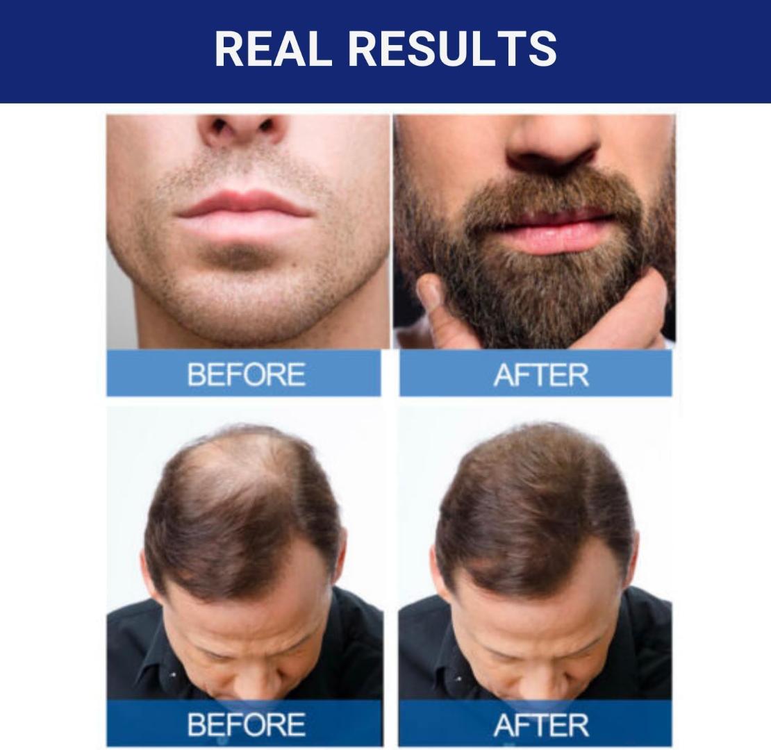 Kirkland Signature Minoxidil 5% Topical Solution for Men. Hair Regrowth Treatment with Dropper.