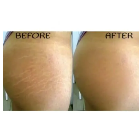 Generic Effective Stretch Marks Snail Cream Anti Stretchmarks Fade