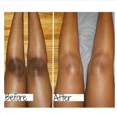 White Secret Dark/Black Spot/Scars Remover/Dark Knuckle,Knees&Elbow-30g.