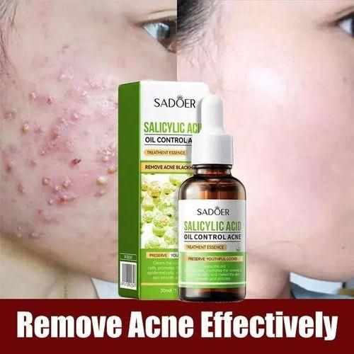 SADOER Salicylic Acid Serum for Face Shrink Pores, Gentle Exfoliating, Salicylic Acid for Anti Acne, Pimple, Spot, Blackhead Salicylic Acid Acne Treatment Essence_30ml