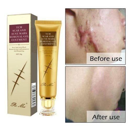 TCM Scar, Acne, Stretch Mark Remover Cream