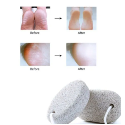 2Pcs Pumice Stone For Feet Scrub & Exfoliating Dead Dry Skin Callus Remover Hands Scrubber