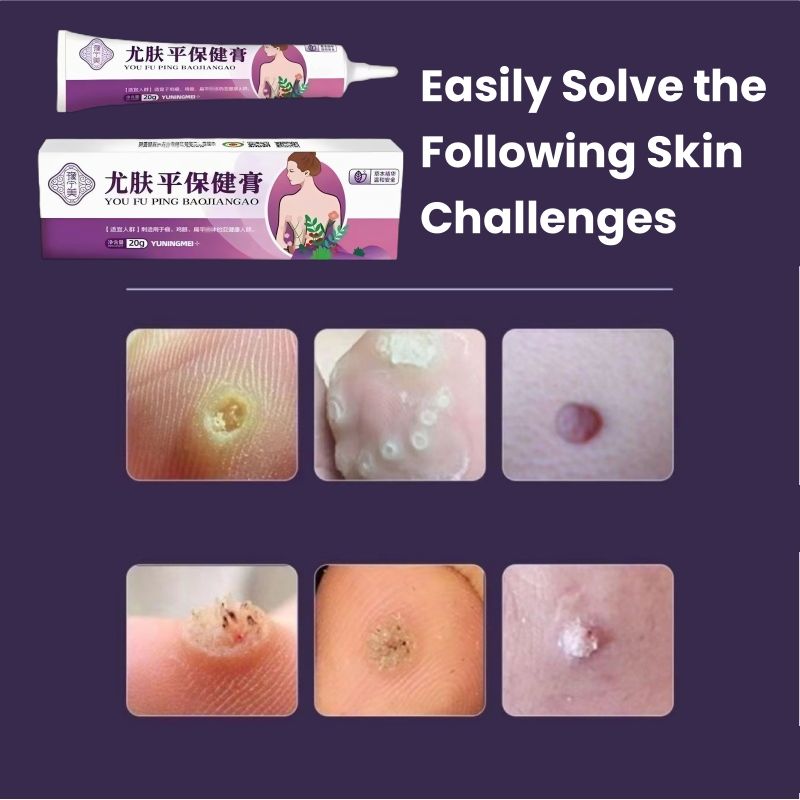 Wart Removal Cream, Ancient Chinese Medical Recipes,removal warts caused by HPV (Human Papilloma Virus) /filiform warts/flat warts/common warts/genital warts/corns/granules/spurs/skin bumps