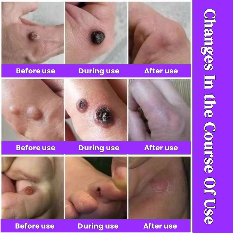 Wart Removal Cream, Ancient Chinese Medical Recipes,removal warts caused by HPV (Human Papilloma Virus) /filiform warts/flat warts/common warts/genital warts/corns/granules/spurs/skin bumps