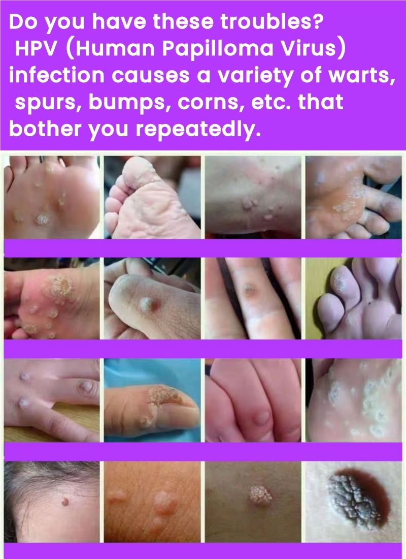 Wart Removal Cream, Ancient Chinese Medical Recipes,removal warts caused by HPV (Human Papilloma Virus) /filiform warts/flat warts/common warts/genital warts/corns/granules/spurs/skin bumps