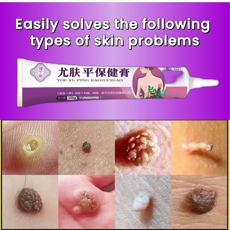Wart Removal Cream, Ancient Chinese Medical Recipes,removal warts caused by HPV (Human Papilloma Virus) /filiform warts/flat warts/common warts/genital warts/corns/granules/spurs/skin bumps