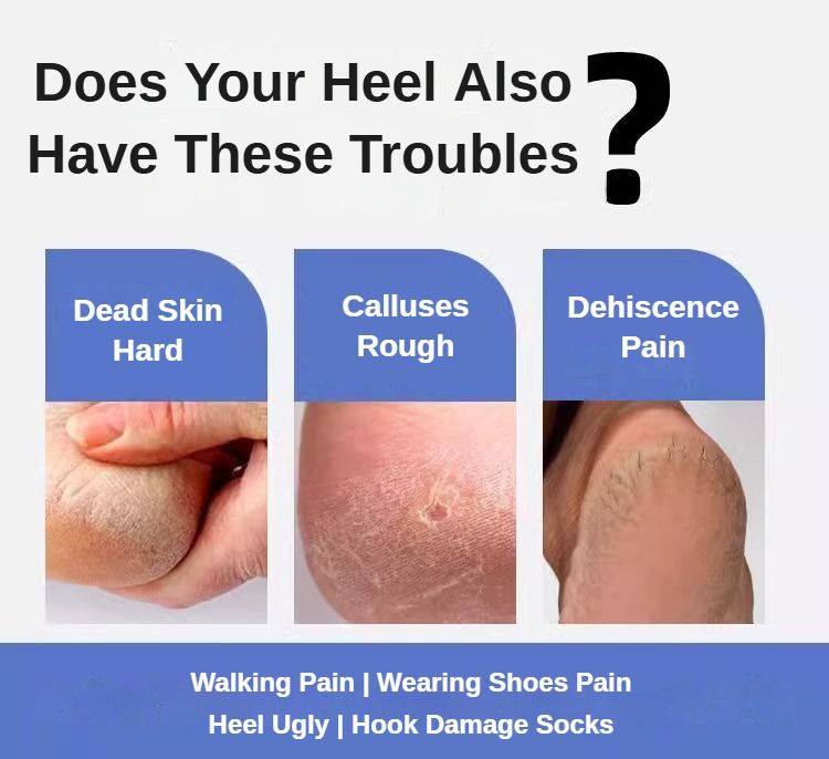 Foot Heel Callus Shaver Home Feet Callosity Razor Dead Skin Shaver Heel Scraper Foot Repair Tools Hard Skin Shaver Foot Care Tool Foot Skin Care Excoliates Cracked Heels Dead Skin Pain Free
