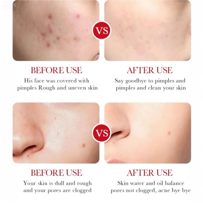 BIOAOUA Skin Care Set Salicylic Acid Acne Removal Cream Treats Pimples Remove Acne Dark Spots Shrinks Pores Oil-Free Budget-Friendly Fade Acne Marks Get Rid Acne Shrink Pores Soothes Redness