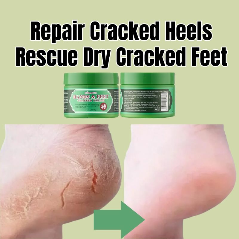 KORMESIC Hands & Feet Chapped Cream Repair Cracked Heels Dry Cracked Feet Rescue Foot Cracks Split Heels Hard Skin & Cracks Heel Fissures Plantar Rhagades Painless Deep Skin Fissures Moisturizer 140g
