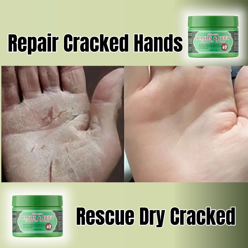KORMESIC Hands & Feet Chapped Cream Repair Cracked Heels Dry Cracked Feet Rescue Foot Cracks Split Heels Hard Skin & Cracks Heel Fissures Plantar Rhagades Painless Deep Skin Fissures Moisturizer 140g