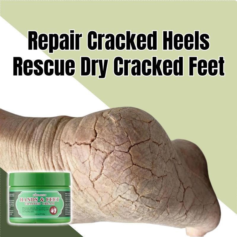 KORMESIC Hands & Feet Chapped Cream Repair Cracked Heels Dry Cracked Feet Rescue Foot Cracks Split Heels Hard Skin & Cracks Heel Fissures Plantar Rhagades Painless Deep Skin Fissures Moisturizer 140g