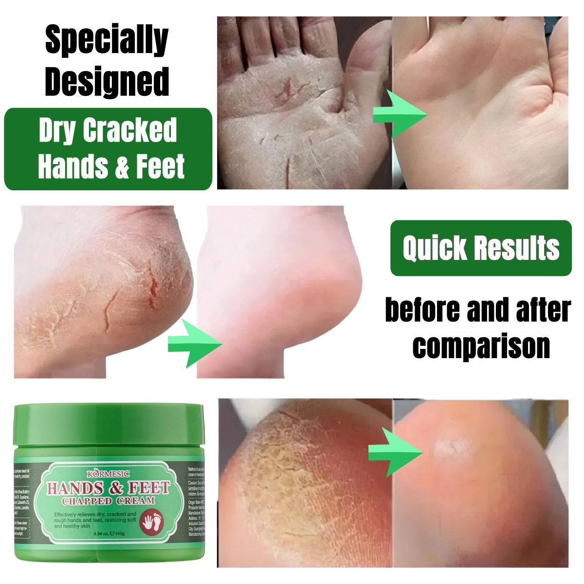 KORMESIC Hands & Feet Chapped Cream Repair Cracked Heels Dry Cracked Feet Rescue Foot Cracks Split Heels Hard Skin & Cracks Heel Fissures Plantar Rhagades Painless Deep Skin Fissures Moisturizer 140g
