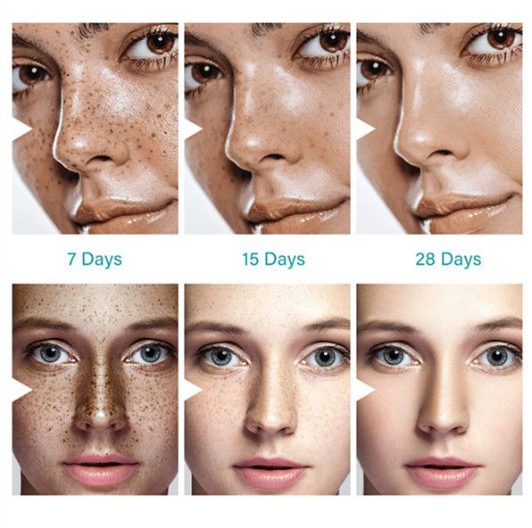 1PC DARK SPOT REMOVAL CREAM  WHITENING FRECKLE CREAM