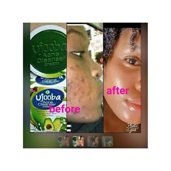 Ujooba G Original Fairness Acne & Pimple Cleanser Beauty CreamUjooba G Original Fairness Acne & Pimple Cleanser Beauty Cream