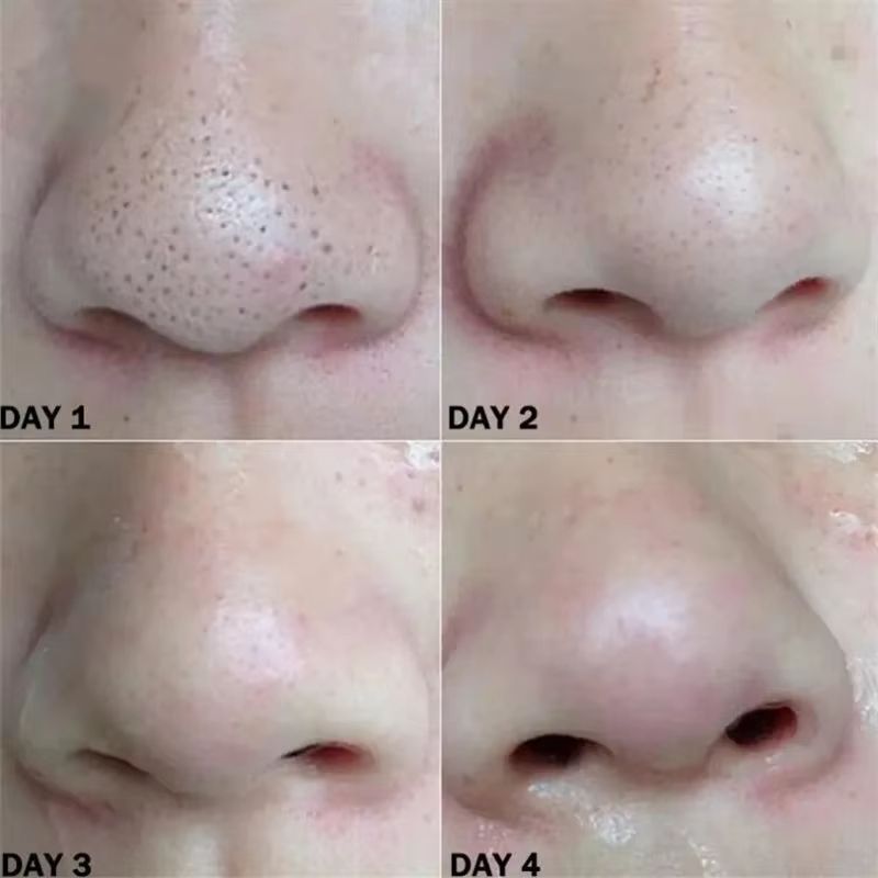 Nose Blackhead Remover Mask Nasal Strips Black Head Nose Dot Spot Peel Skin Care Shrink Pore Black dots Pore Clean Strips