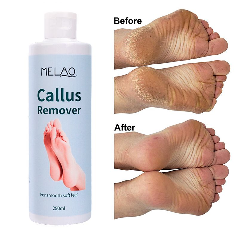 Private Label Organic Foot Peel Exfoliator Gel for Moisturizing Anti Inflammatory Foot Callus Remover  1 bottle 250ml