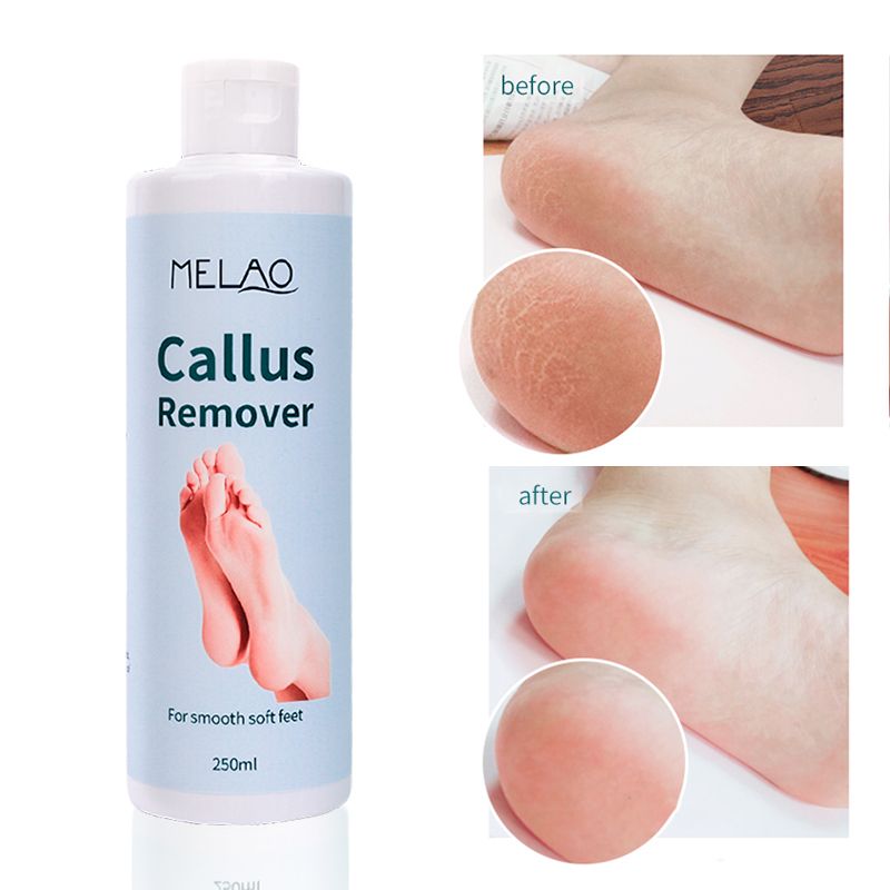 Private Label Organic Foot Peel Exfoliator Gel for Moisturizing Anti Inflammatory Foot Callus Remover  1 bottle 250ml