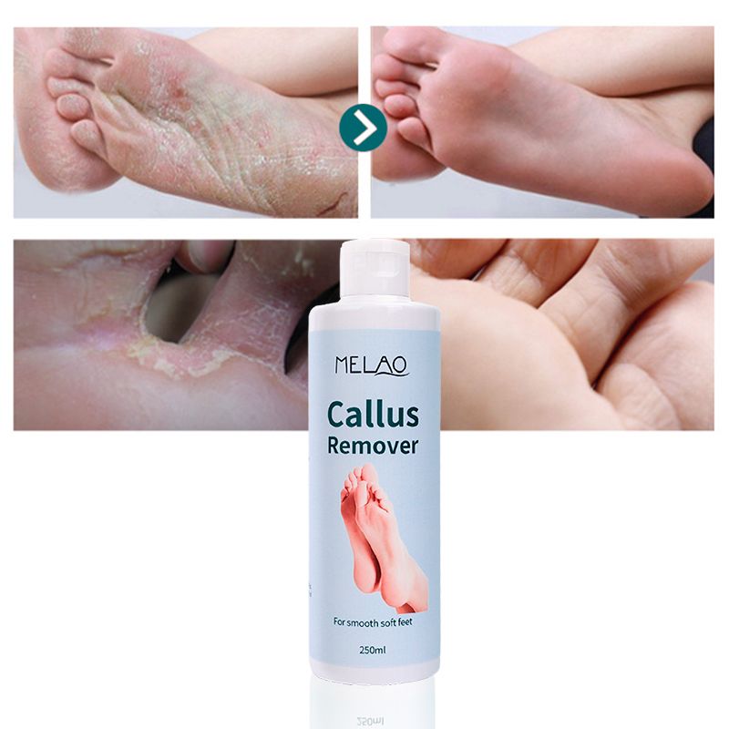 Private Label Organic Foot Peel Exfoliator Gel for Moisturizing Anti Inflammatory Foot Callus Remover  1 bottle 250ml