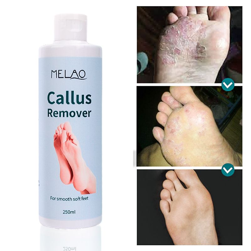 Private Label Organic Foot Peel Exfoliator Gel for Moisturizing Anti Inflammatory Foot Callus Remover  1 bottle 250ml
