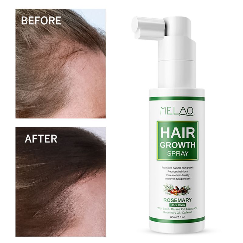 Hair Growth Spray Unisex Hair Growth Spray No-rinse Natural Anti-hair Loss Treatment 1 Bottle 60ML