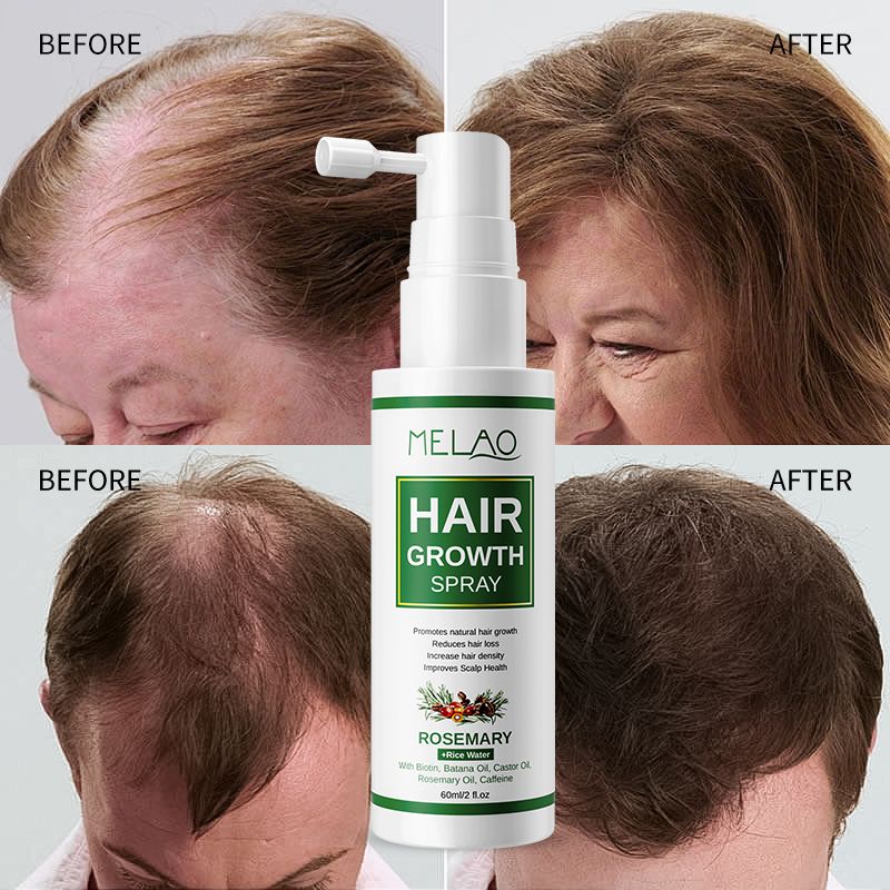 Hair Growth Spray Unisex Hair Growth Spray No-rinse Natural Anti-hair Loss Treatment 1 Bottle 60ML