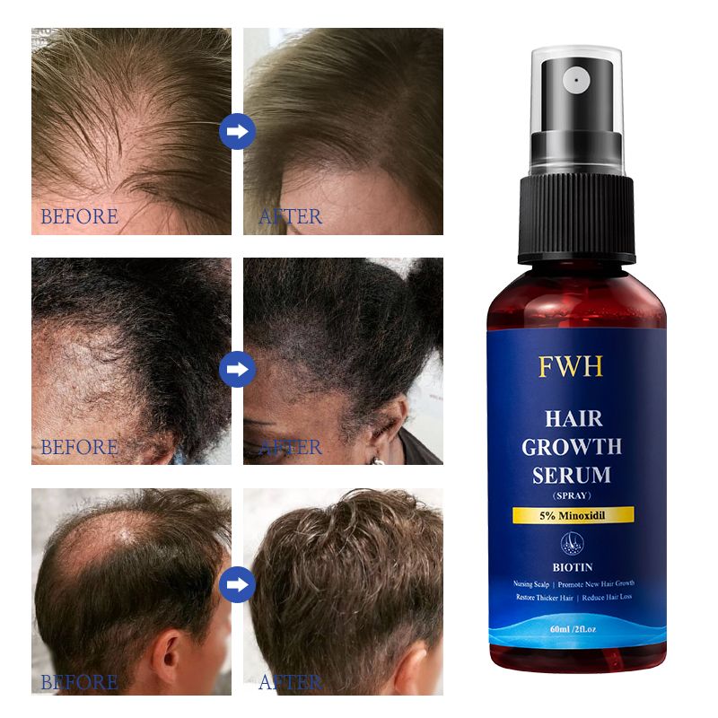FWH Hair Growth Serum Spray - 5% Minoxidil and Biotin Formula, Promotes Hair Growth and Thicker Hair, Reduces Hair Loss, Nourishes Scalp, 1 bottle 60ml