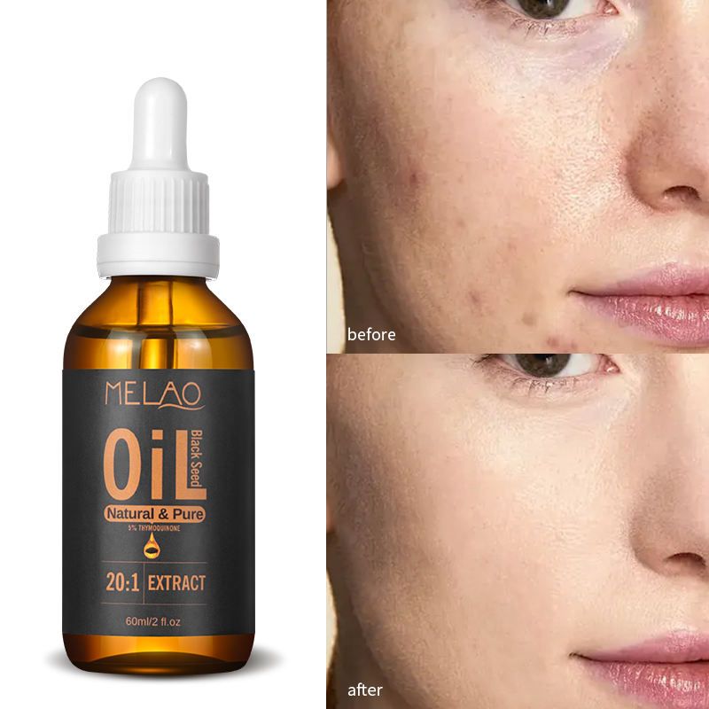 MELAO 20:1 Black Seed Oil - Natural Pure Extract, Suitable for Skin Care and Hair Care, Promotes Hair Growth Nourishes Skin 1 Bottle 60ml
