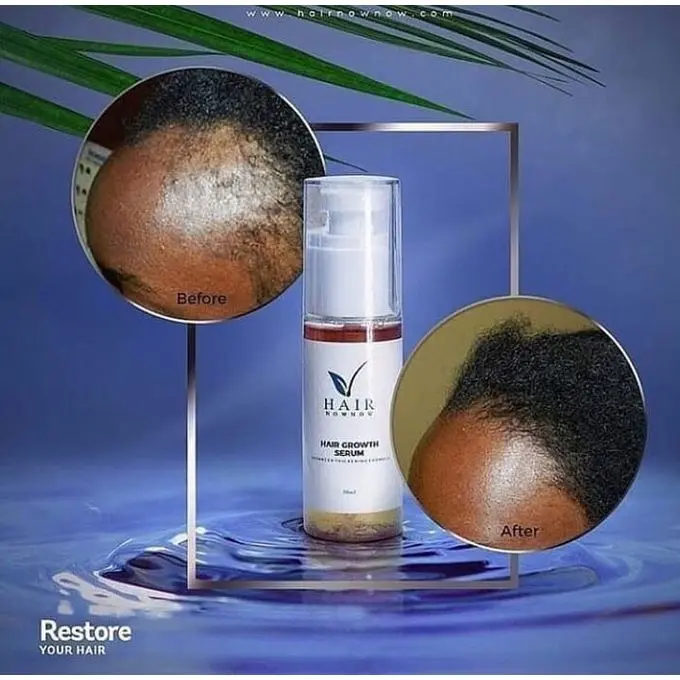 Hair Now Hair Growth Serum Promotes Hair Growth & Restores Hairline Delays Balding