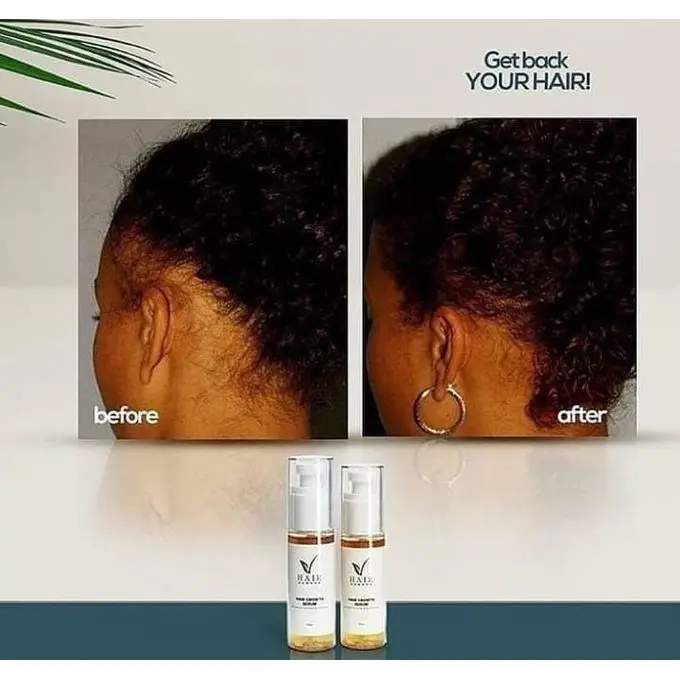 Hair Now Hair Growth Serum Promotes Hair Growth & Restores Hairline Delays Balding