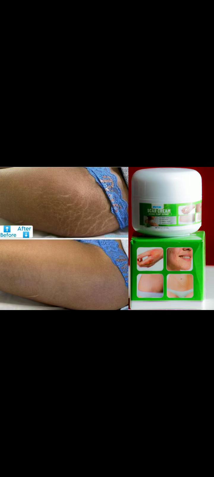 scar cream